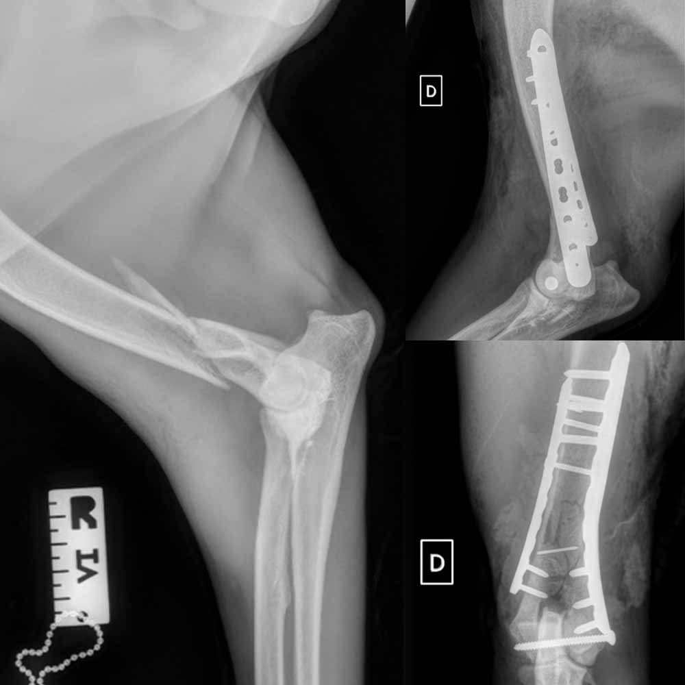 Conduite à tenir face à une fracture humérale en Y ou en T