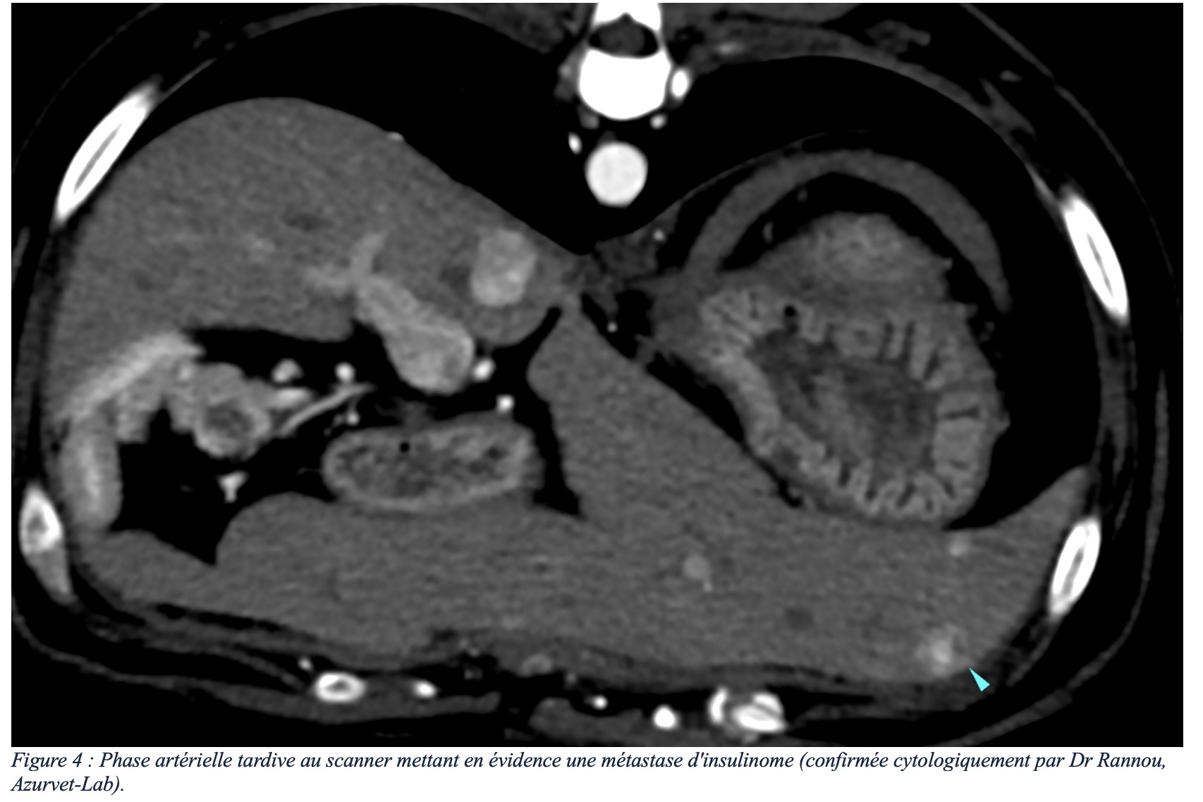 L’importance de l’imagerie lors d’insulinome