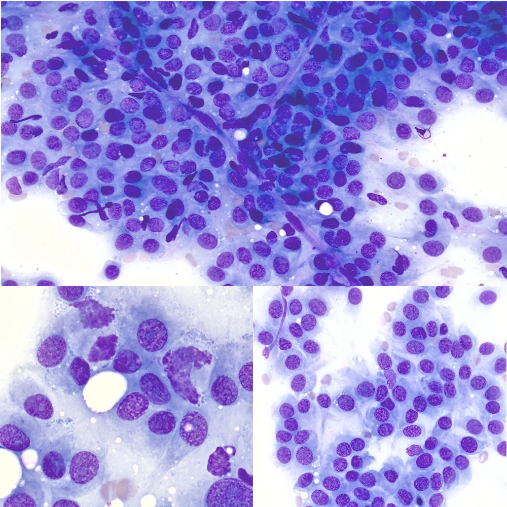 Que voyez-vous dans cette cytoponction à l’aiguille fine ?